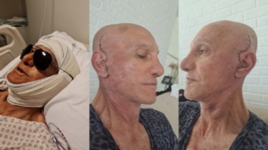 Amin Khader com o rosto enfaixado no hospital e em fotos de perfil com os pontos da cirurgia plástica na cabeça 