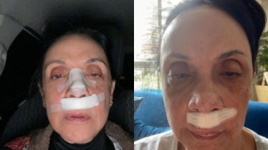 Cininha de Paula em selfies com curativos no rosto 