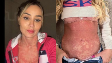 Ex-BBB Letícia Santiago mostra reação alérgica na pele  