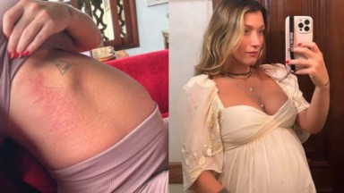 Gabriela Pugliesi está grávida e com uma alergia na barriga 