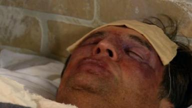 Jerônimo dormindo com hematomas no rosto e um lenço na testa   