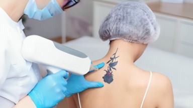 profissional usando laser para remoção de tatuagem na nuca 