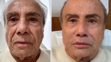 Stenio Garcia em antes e depois dos procedimentos estéticos 