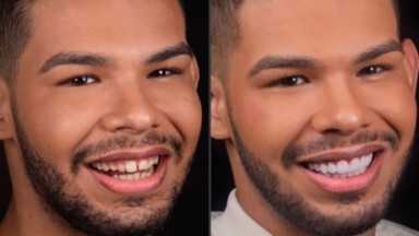 "Antes e depois" postado em rede social mostra resultado de lentes de contato que Vyni colocou nos dentes 