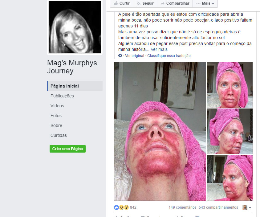 Mulher sofre fortes lesões no rosto após ficar viciada em bronzeamento