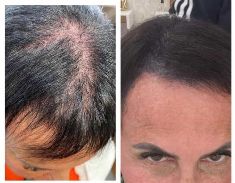 Gretchen mostra antes e depois de tratamento contra calvície