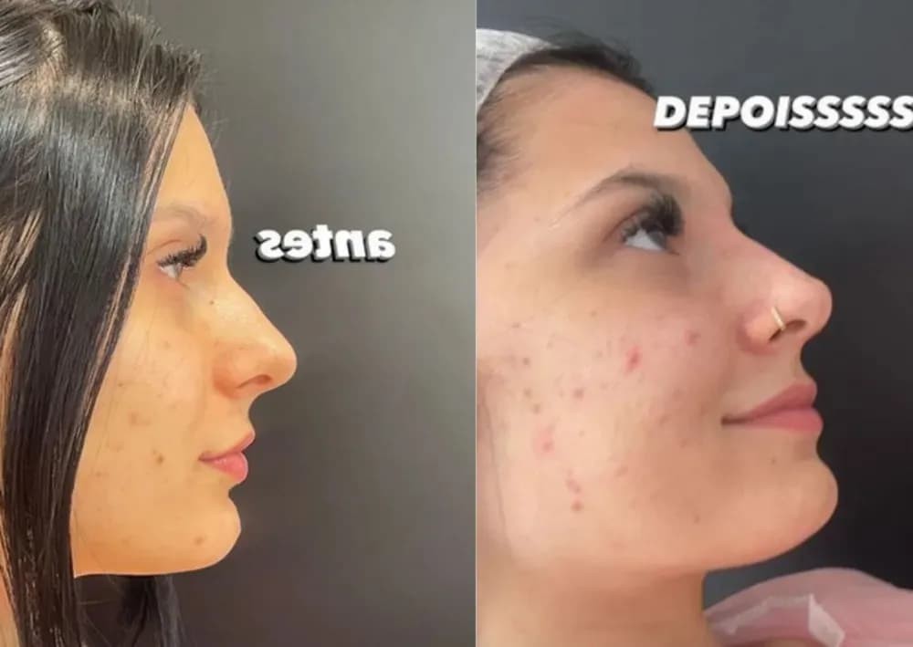 Ana Castela mostra antes e depois de plástica no nariz