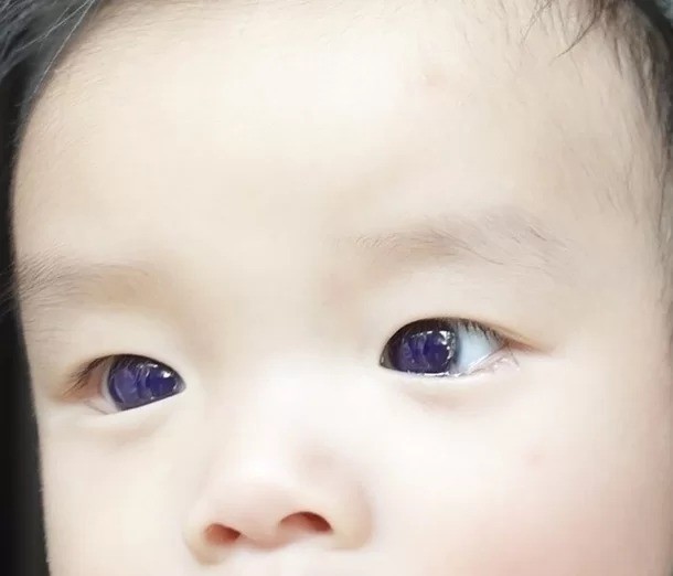 Olhos de bebê mudam de cor após Covid