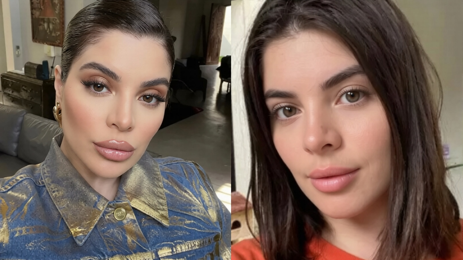Voltaram atrás: 7 famosas que reverteram procedimentos faciais