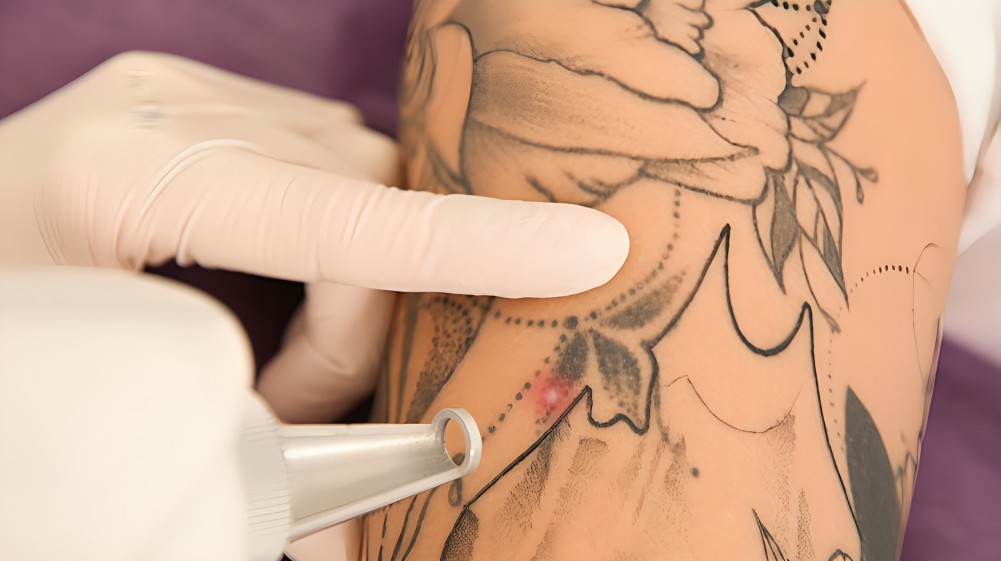 Conheça os tratamentos a laser para remoção de tatuagem