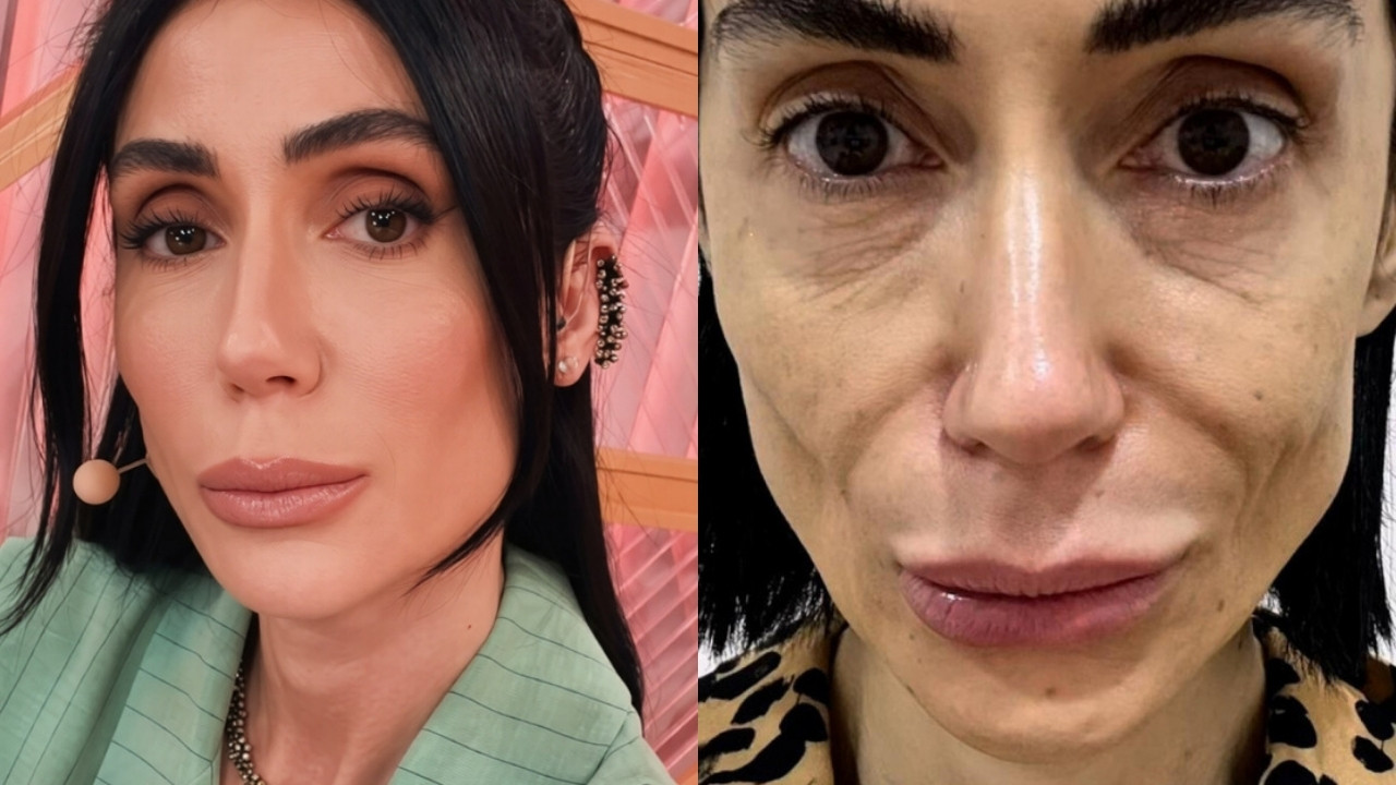 Voltaram atrás: 7 famosas que reverteram procedimentos faciais