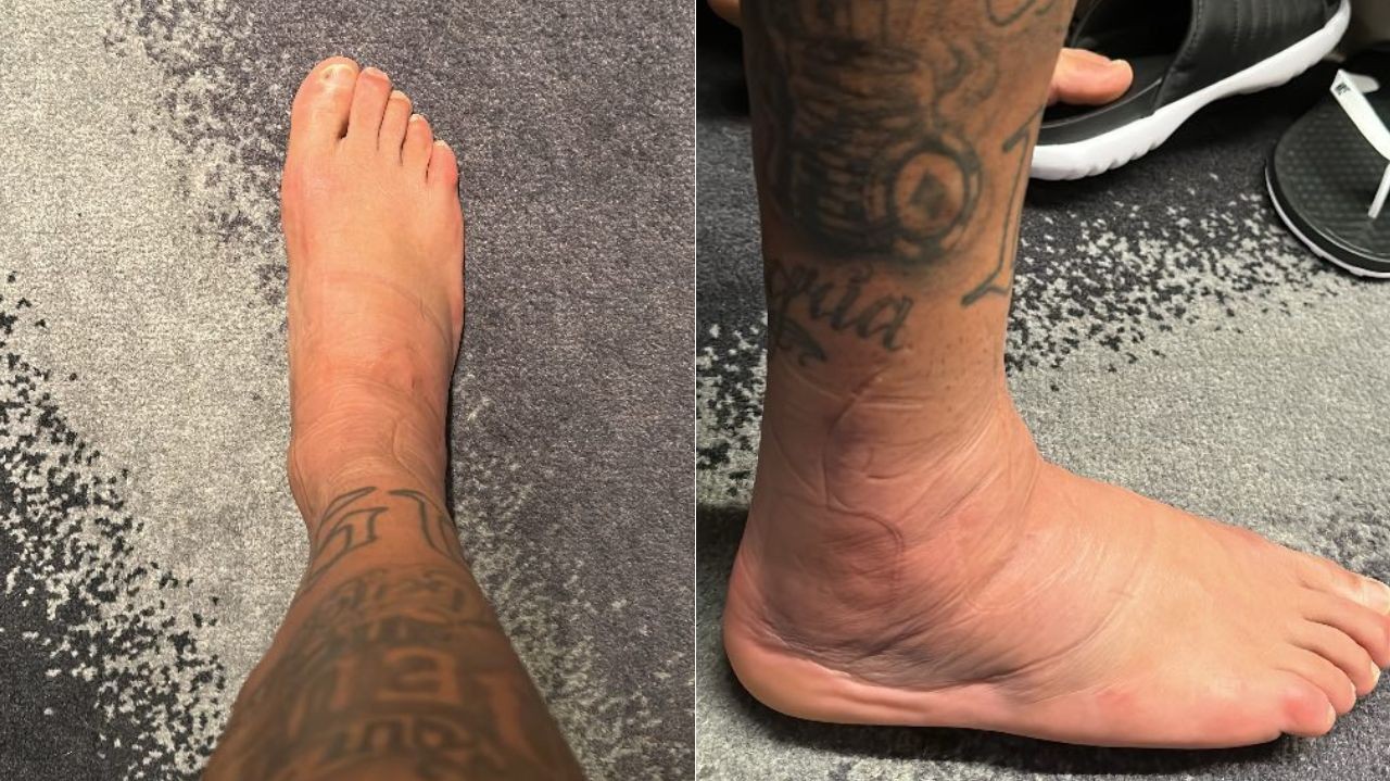 Neymar impressiona web com foto de tornozelo machucado