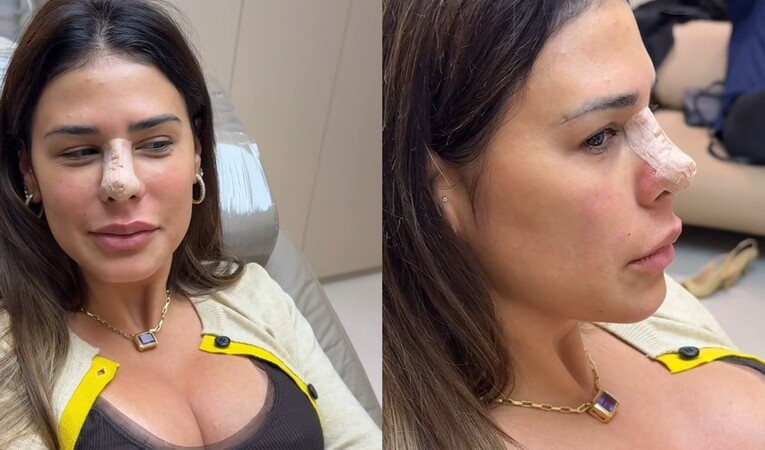 Simone Mendes brinca com resultado de cirurgia no nariz: \"Preciso acreditar que vai dar certo\"