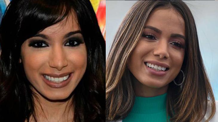 O antes e depois da Anitta