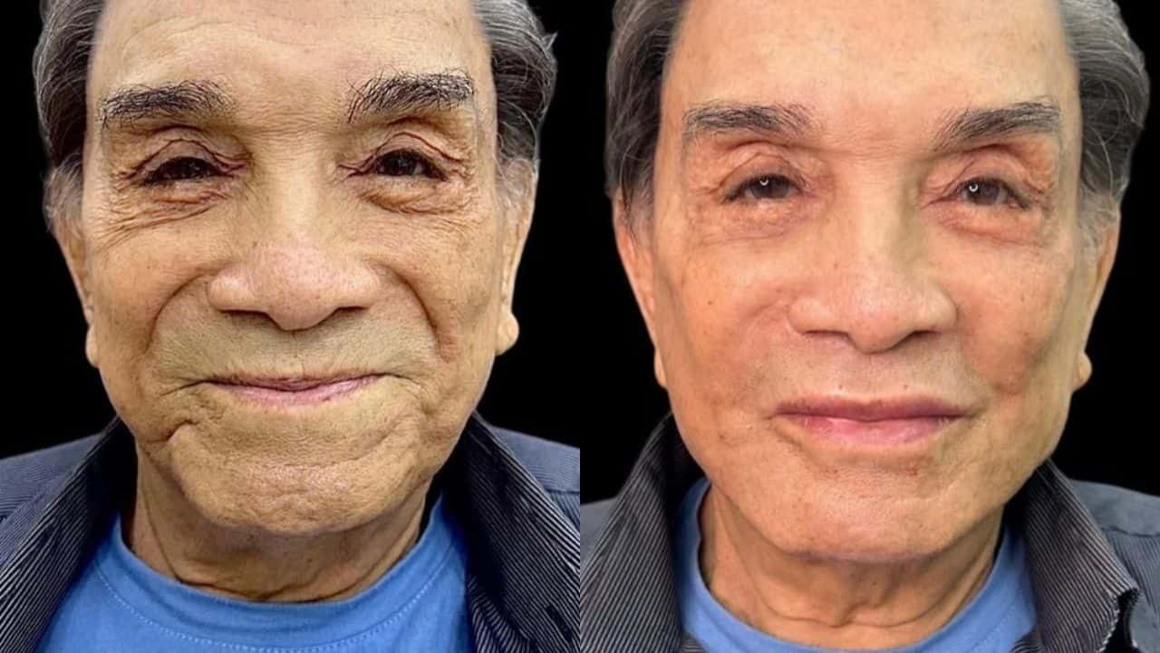 Antes e depois de Dedé Santana, que fez harmonização facial