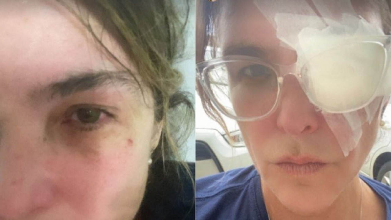 Cristiana Oliveira em montagem com o olho machucado e com um tampão
