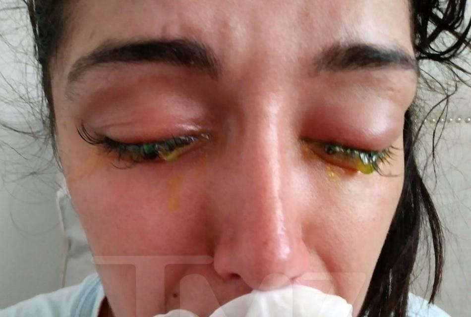 Mulher que processa Chris Brown por lesões nos olhos divulga foto chocante