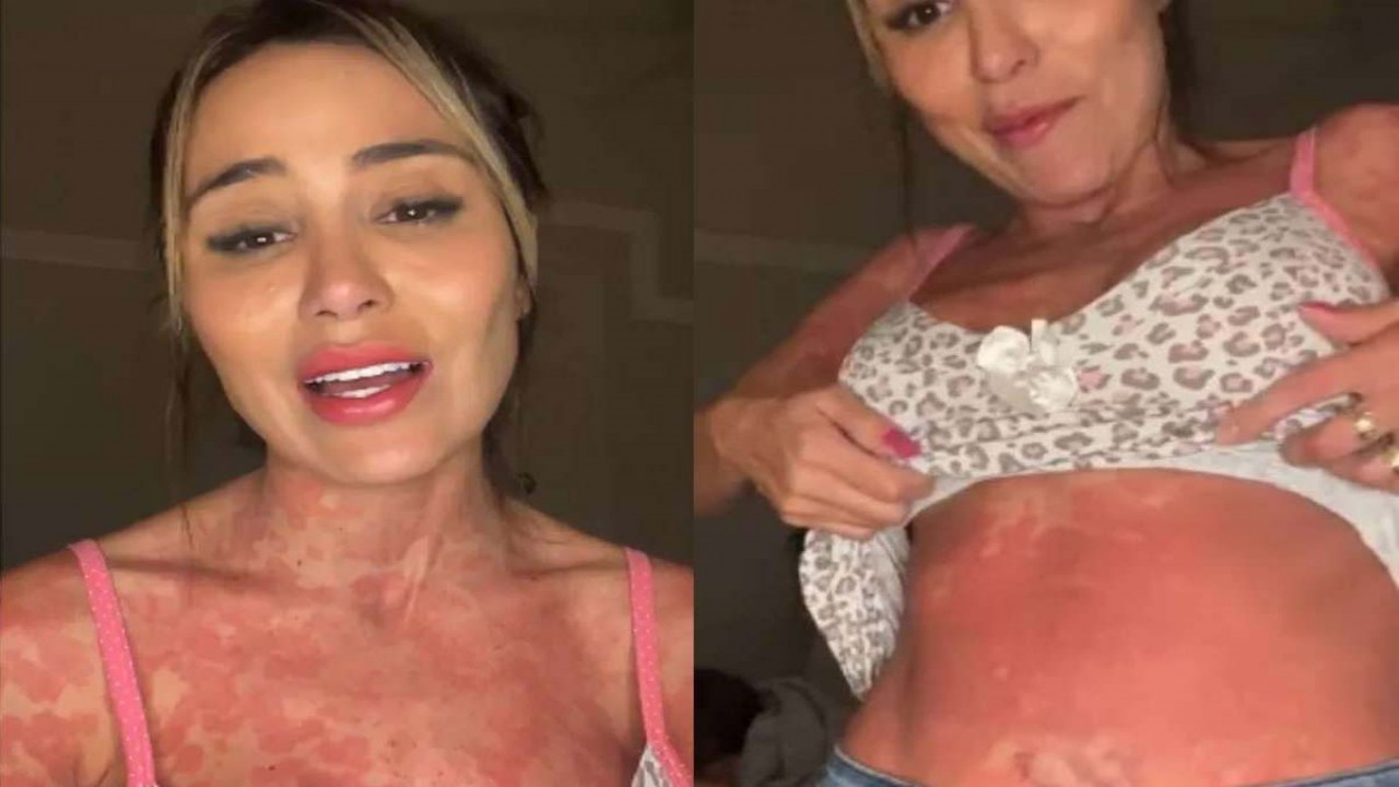 Letícia Santiago mostrando manchas na pele
