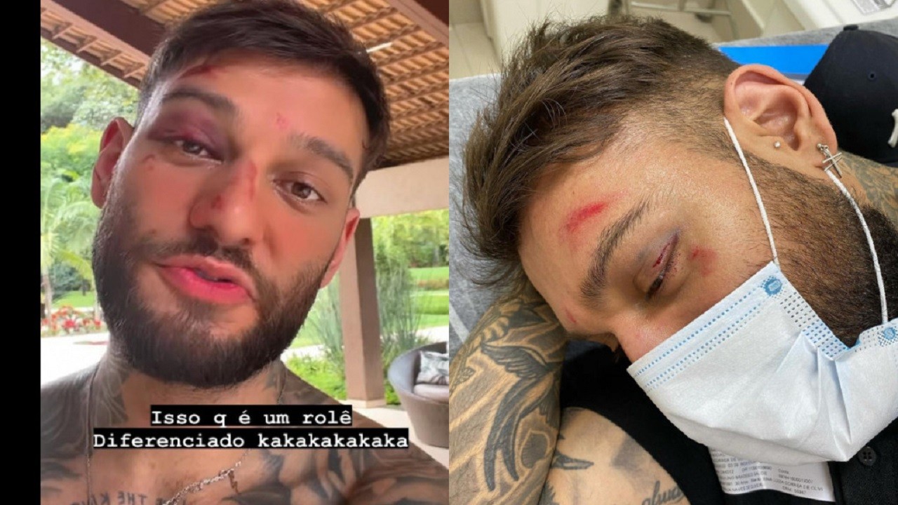 Lucas Lucco com o olho roxo e ferimentos no rosto após sofrer acidente doméstico 