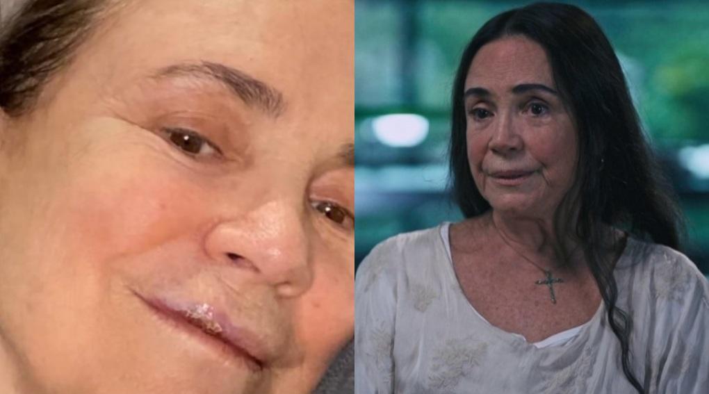 Regina Duarte relatou ter sofrido acidente há duas semanas em São Paulo; atriz machucou a boca e quebrou dentes