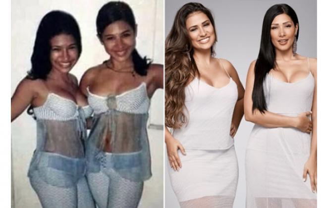 Antes e depois: As cantoras famosas que recorreram ao bisturi e se transformaram