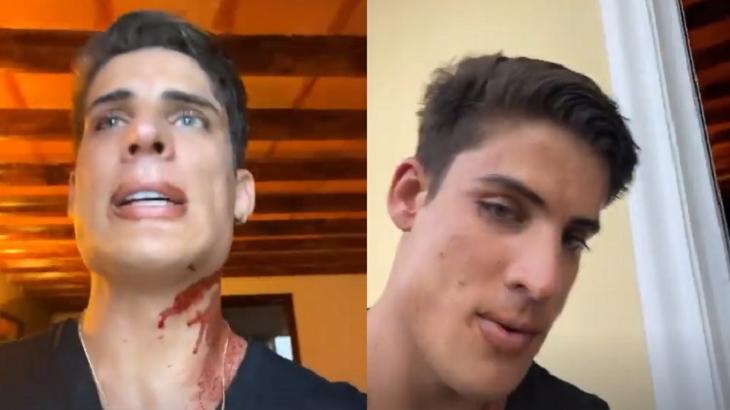 Tiago Ramos com sangue após brigar no México