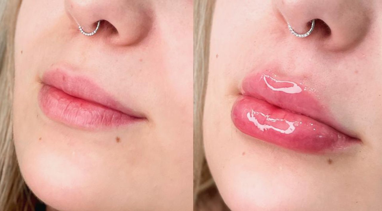 Viih Tube faz preenchimento labial; veja antes e depois